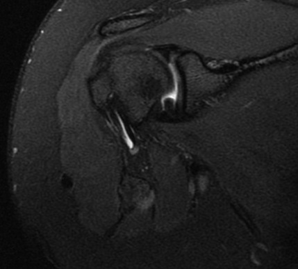 Figure 3 for case osteochondroma ( RID4136 )